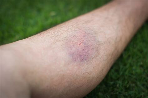 Harmless Bruise Vs Dangerous Blood Clot The Difference Scary Symptoms