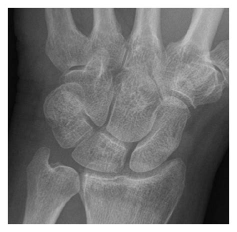 Dorsal Triquetral Fracture Of The Left Wrist In A 30 Year Old Man After