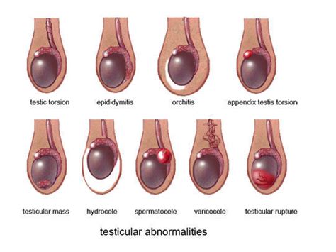 Testicular Cancer Signs Ultrasound Scan Dublin Ultrasound Dimensions