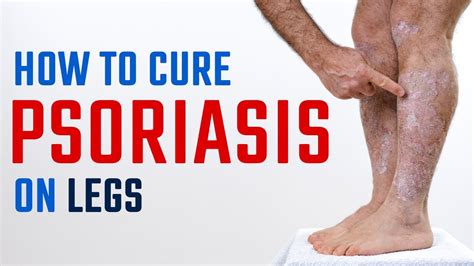 How To Cure Psoriasis On Legs Psoriasis Treatment Dr Megha