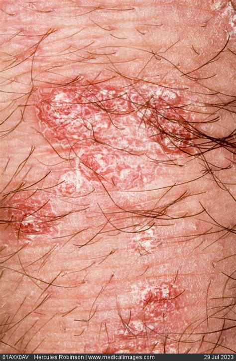 Stock Image Dermatology Psoriasis Multiple Pink Patches With White