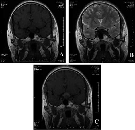 Figure 1 From Isolated Intracranial Rosai Dorfman Disease Mimicking