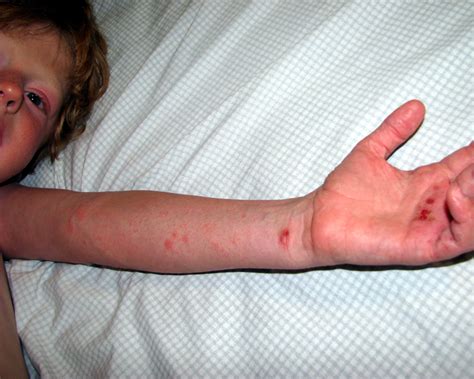 Eczema And Dishydrosis On Hand Eczema On Arm Flickr Photo Sharing