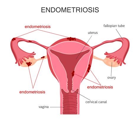 Endometriosis A Painful Yet Treatable Condition For Women Mn