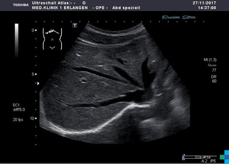 Liver Ultrasound Anatomy