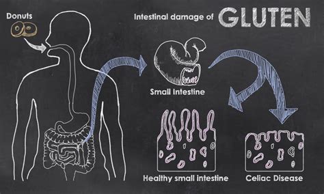 Celiac Disease Vs Gluten Intolerance What Do You Have