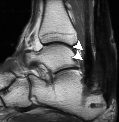 Ct And Mr Imaging Of The Postoperative Ankle And Foot Radiographics