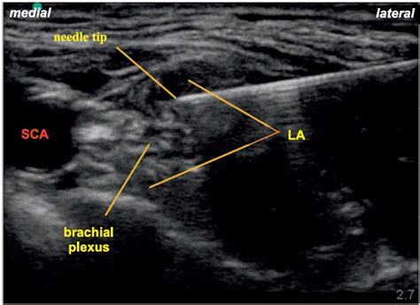 Ultrasound Guided Supraclavicular Brachial Plexus Block Wfsa Resources