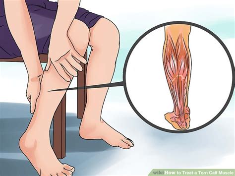 How To Treat A Torn Calf Muscle Steps With Pictures