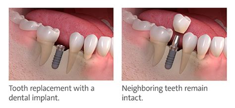Dental Implants Crown Dental News Network