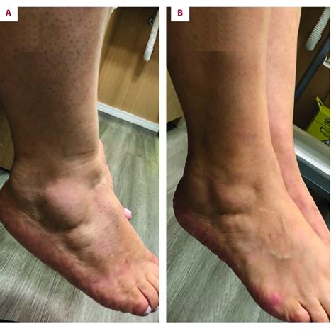 Patient With Stage 1 Lipedema Before A And After B Treatment