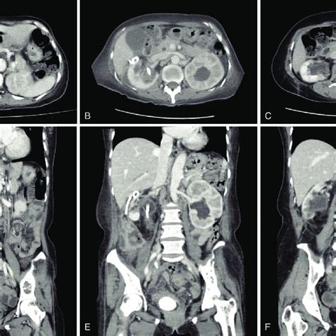 A D Abdominal Computed Tomography Ct Scans On Admission