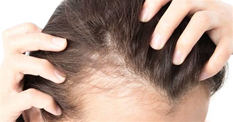 Alopecia What Is It What Are Its Symptoms And How To Treat