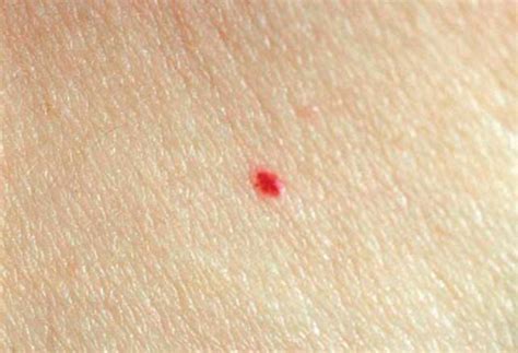 Cherry Angioma On Lip Bleeding Treating Anigoma Pure Dermatology