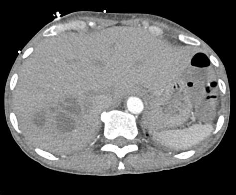 Liver Abscess Due To Diverticulitis Liver Case Studies Ctisus Ct