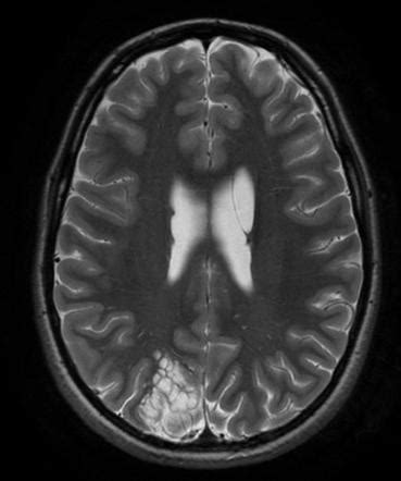 Dysembryoplastic neuroepithelial tumour | Image | Radiopaedia.org