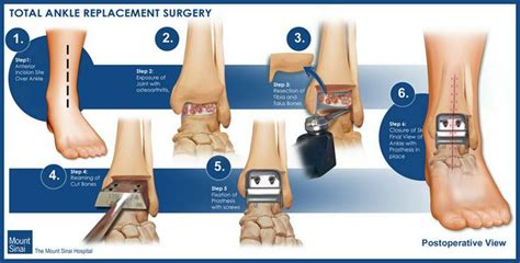 Ankle Replacement Surgery Ankle Exercises