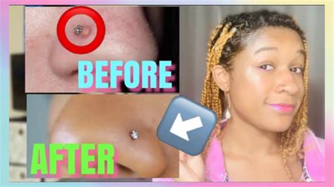How To Get Rid Of A Bump Keloid On Nose Piercing Fastreal Divyne Youtube