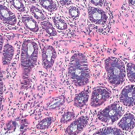 Colonic Biopsy Demonstrated Mucosal Infiltration By Inflammatory Cells