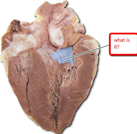 Main tributary of the coronary sinus. front
