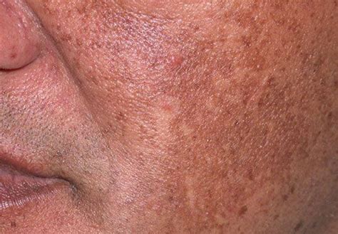 Hyperpigmentation Skin Condition Contour Dermatology