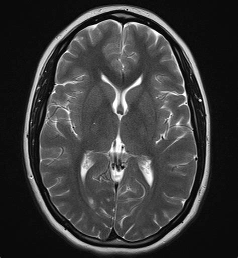 Normal brain MRI and venogram | Image | Radiopaedia.org