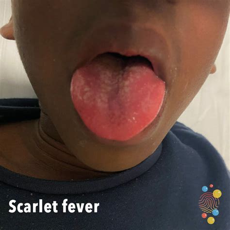 Strep A And Scarlet Fever