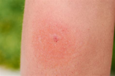 Infection Of A Mosquito Bite On A Childs Leg Stock Photo Download