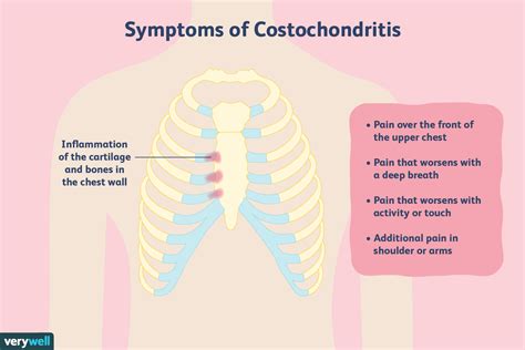Was Ist Costochondritis Medde