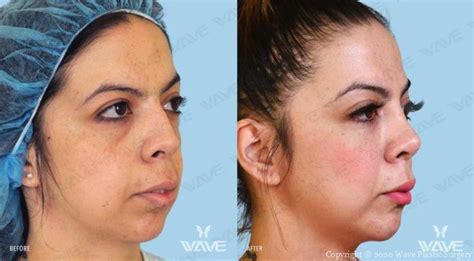 Mid Facelift In Los Angeles Wave Plastic Surgery
