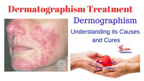 Dermatographism Treatment Dermographism Understanding Its Causes