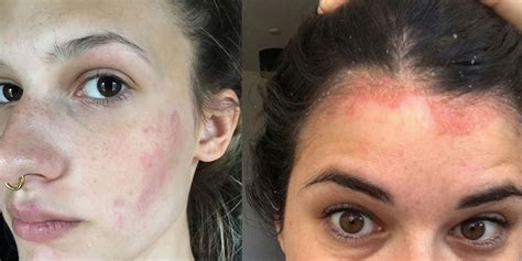 8 Instagram Accounts That Break The Skin Disorder Stigma