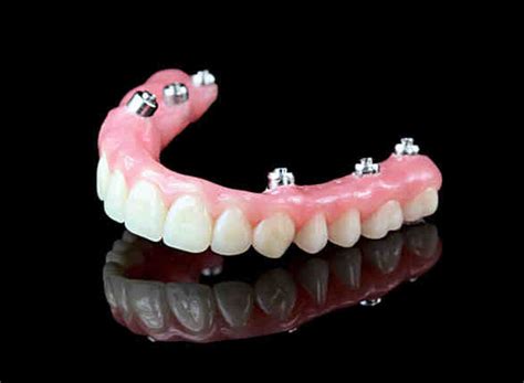 What Is Hybrid Dental Implants Dental News Network