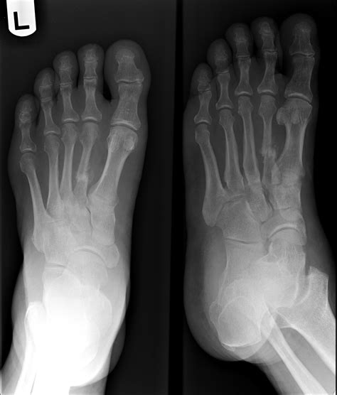 A lisfranc injury, also referred to as a midfoot injury, occurs when the bones in the midfoot are broken or ligaments that support the. Lisfranc Injuries - Core EM