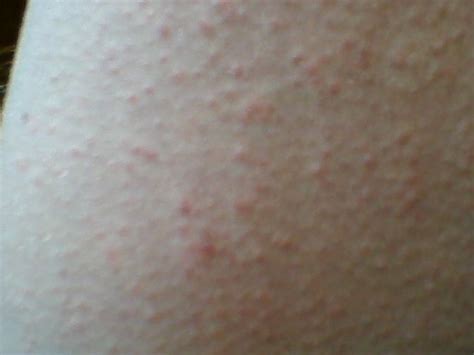 Skin Rash That Looks Like Pimples And Bumps Itches Alot In Evening And