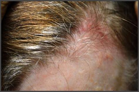 Pictures Of Shingles On The Scalp Shingles Expert