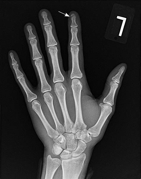 Common Finger Fractures And Dislocations Aafp
