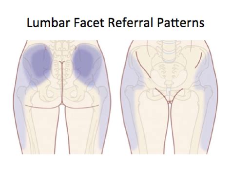 The Referral Patterns Of The Sacroiliac Joint Facet Joints And
