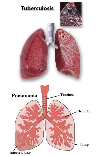 Differences Between Pneumonia And Tuberculosis