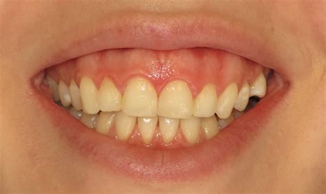 Dermal Lip Filler Juvederm Charlton Dentistry