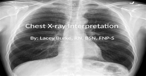 Chest Xray Interpretation Pptx Powerpoint