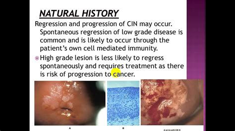 Benign Malignant Lesions Of The Cervix YouTube