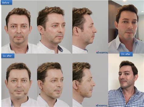 Mens Plastic Surgery Types Of Surgeries For Men Idhospital