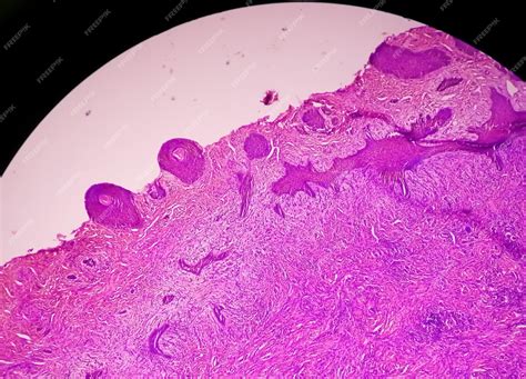 Biopsia Cutanea Al Microscopio Suggestiva Di Carcinoma A Cellule Basali