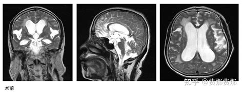 可以治愈的老年痴呆——正常压力脑积水！ 知乎