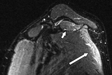 Anatomy Imaging And Pathologic Conditions Of The Brachial Plexus