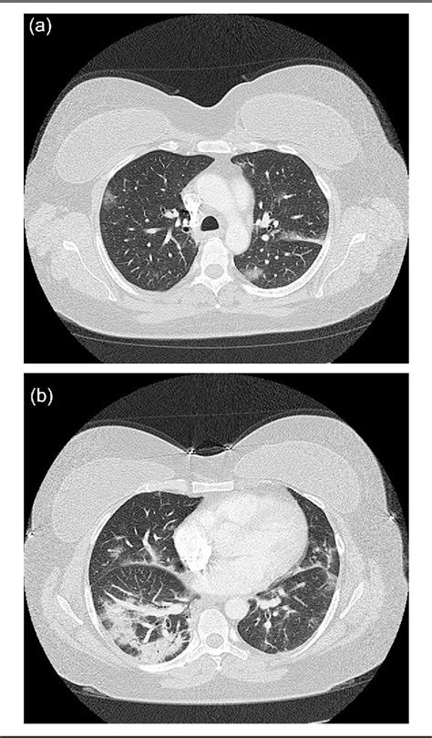 Figure 2 From An Acute Pulmonary Coccidioidomycosis Coinfection In A