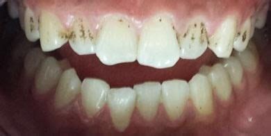 Over time, dentin naturally yellows and enamel gets thinner, so the dentin is more visible. How do you get rid of black spots on teeth? | Black teeth ...