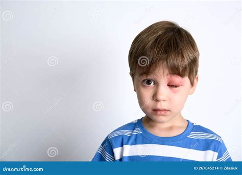 A Boy With Swollen Eye From Insect Bite Quincke Edema Portrait Of
