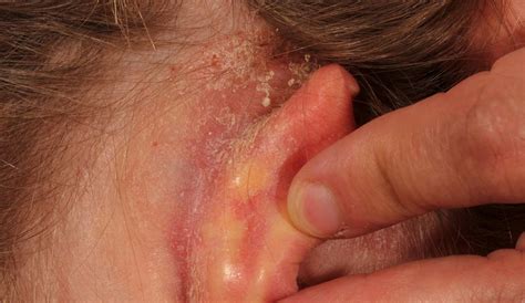 Crusty Behind Ears Causes Symptoms Dry Skin Psoriasis Skin